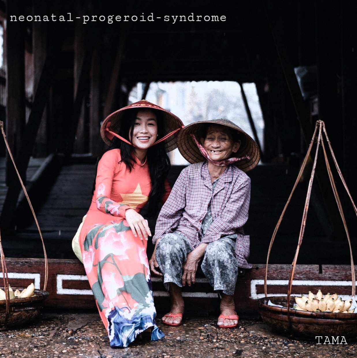 Neonatal Progeroid Syndrome