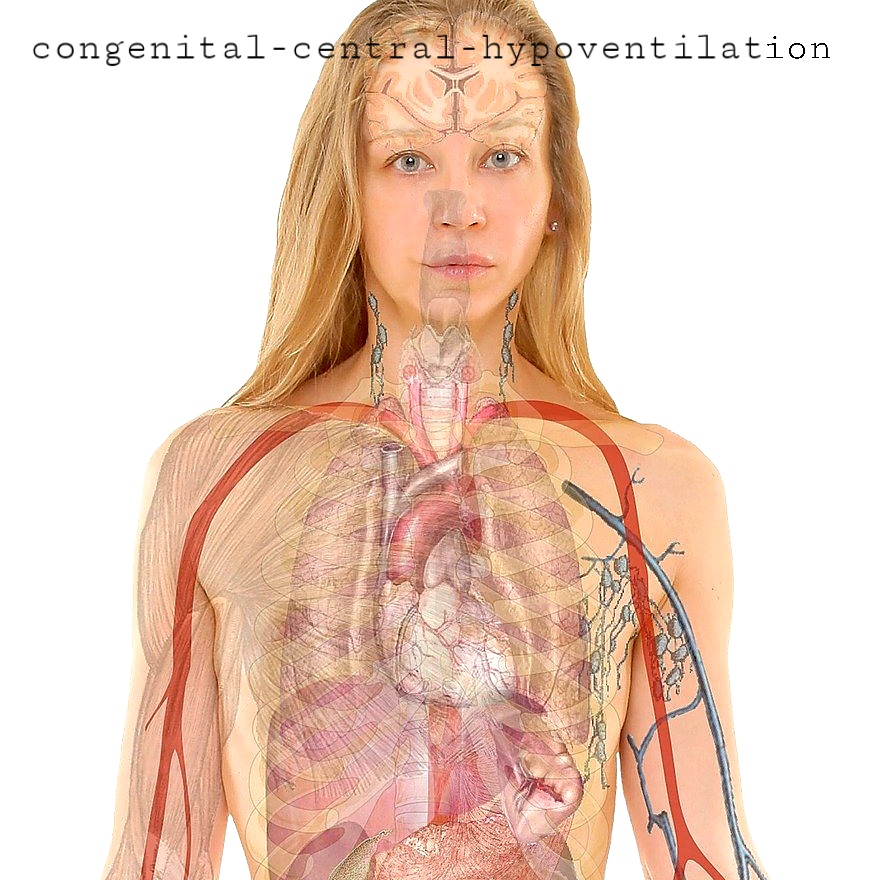 Congenital Central Hypoventilation Syndrome